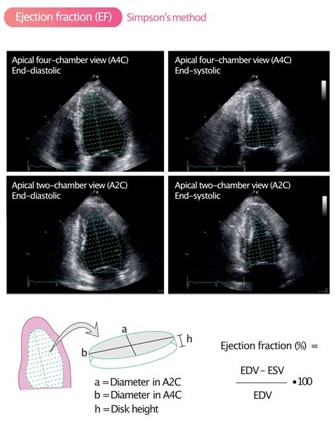 echocardiogram measure ejection fraction.